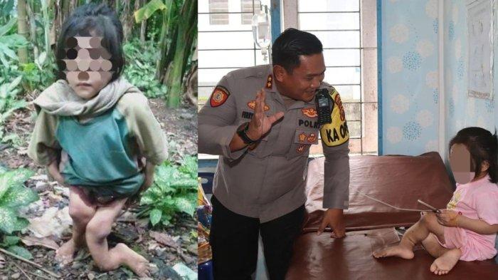 Bocah Nias Disiksa Sekeluarga Hingga Cacat